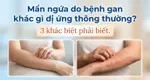 Mẩn ngứa do bệnh gan khác gì dị ứng thông thường? 3 khác biệt phải biết