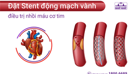 Đặt Stent động mạch vành điều trị nhồi máu cơ tim