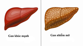 Gan nhiễm mỡ nhẹ: Dấu hiệu nhận biết và cách bảo vệ gan