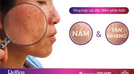 5 Điểm phân biệt rõ rệt giữa da bị nám và tàn nhang