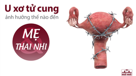 U xơ tử cung ảnh hưởng thế nào đến mẹ và thai nhi
