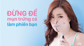 Đừng để mụn trứng cá làm phiền bạn