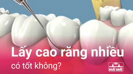 Lấy cao răng nhiều có tốt không và cách chăm sóc răng miệng sau khi lấy cao răng