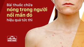 Bài thuốc chữa nóng trong người nổi mẩn đỏ hiệu quả tức thì