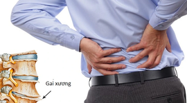 Bệnh gai cột sống thắt lưng – Giải pháp điều trị ít người biết!