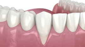 Bị tụt lợi nên uống thuốc gì? Chăm sóc răng miệng để ngăn ngừa tụt lợi