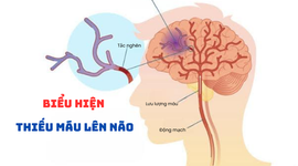 Biểu hiện của thiếu máu lên não: Đừng bỏ qua!