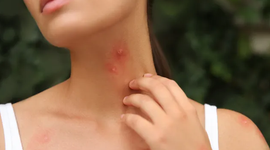Làm thế nào để xử lý khi bị côn trùng cắn nổi mụn nước?