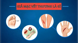 Giả mạc vết thương là gì: Tìm hiểu về lớp màng bảo vệ vết thương