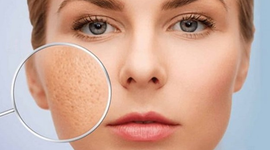 Da nhờn, lỗ chân lông to: Nguyên nhân và cách khắc phục