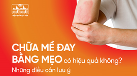 Chữa mề đay bằng mẹo có hiệu quả không? Những điều cần lưu ý