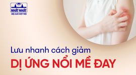 Lưu nhanh cách giảm dị ứng nổi mề đay ngứa ngáy
