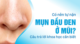 Có nên tự nặn mụn đầu đen ở mũi: Câu trả lời khoa học cần biết