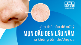 Làm thế nào để xử lý mụn đầu đen lâu năm mà không tổn thương da