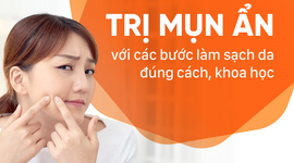 Trị mụn ẩn với các bước làm sạch da đúng cách, khoa học