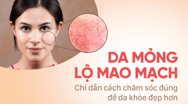 Da mỏng lộ mao mạch: Chỉ dẫn cách chăm sóc đúng để da khỏe đẹp hơn