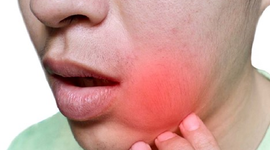 Viêm lợi sưng má: Đừng chủ quan kẻo ân hận!