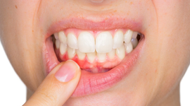 Nhiệt miệng chân răng: Nguyên nhân, triệu chứng và các biện pháp điều trị