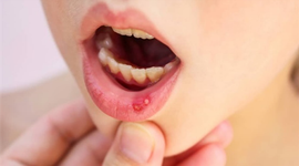 Nhiệt miệng ở trẻ em – Không nên chủ quan! 