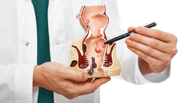 Trĩ nội độ 2: Hiểu đúng và điều trị kịp thời