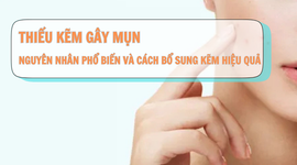 Thiếu kẽm gây mụn: Nguyên nhân phổ biến và cách bổ sung kẽm hiệu quả