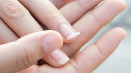 Tư vấn: Móng tay giòn dễ gãy là bệnh gì, có nguy hiểm không?