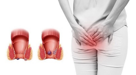 Giải đáp nhanh: Người bị trĩ nội nên kiêng gì?