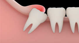 Sưng nướu răng khôn: Cách khắc phục ngay tại nhà