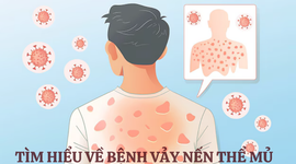 Vảy nến thể mủ: Cách điều trị và ngăn ngừa sẹo hiệu quả cao