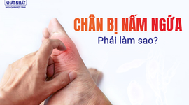 Giải đáp nhanh thắc mắc: Chân bị nấm ngứa phải làm sao?