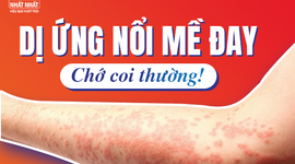 Dị ứng nổi mề đay: Chớ coi thường!