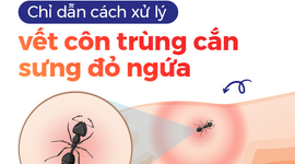 Chỉ dẫn cách xử lý vết côn trùng cắn sưng đỏ ngứa