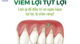 Viêm lợi tụt lợi: Làm gì để điều trị và ngăn ngừa tụt lợi, lộ chân răng?