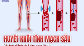 Huyết khối tĩnh mạch sâu: Các dấu hiệu điển hình và biện pháp điều trị hiệu quả