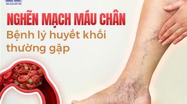 Nghẽn mạch máu chân: Bệnh lý huyết khối thường gặp