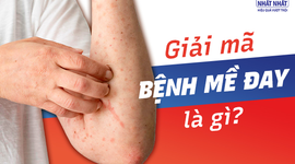 Giải mã bệnh mề đay là gì và cách khắc phục nhanh chóng nhất