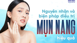 Nguyên nhân và các biện pháp điều trị mụn nang hiệu quả