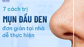 7 cách trị mụn đầu đen đơn giản tại nhà dễ thực hiện