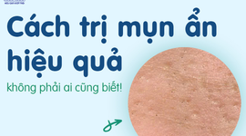 Cách trị mụn ẩn hiệu quả, không phải ai cũng biết!