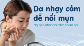 Da nhạy cảm dễ nổi mụn: Nguyên nhân và cách chăm sóc