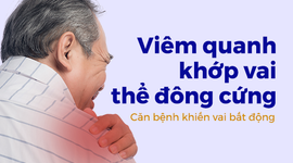 Viêm quanh khớp vai thể đông cứng – Căn bệnh khiến vai bất động