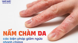 Nấm chàm da – tiết lộ các biện pháp giảm ngứa nhanh chóng