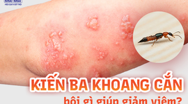 Kiến ba khoang cắn bôi gì giúp giảm viêm, ngăn ngừa sẹo?