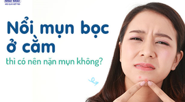 Nổi mụn bọc ở cằm thì có nên nặn mụn không?