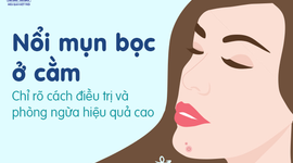 Nổi mụn bọc ở cằm: Chỉ rõ cách điều trị và phòng ngừa hiệu quả cao