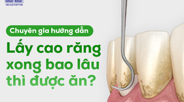 Chuyên gia hướng dẫn: Lấy cao răng xong bao lâu thì được ăn?