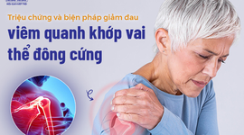 Các triệu chứng và biện pháp giảm đau viêm quanh khớp vai thể đông cứng