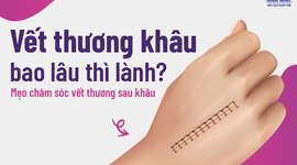 Vết thương khâu bao lâu thì lành? Mẹo chăm sóc vết thương sau khâu