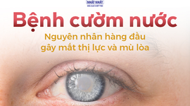 Bệnh cườm nước: Nguyên nhân hàng đầu gây mất thị lực và mù lòa 