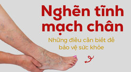 Nghẽn tĩnh mạch chân – Những điều cần biết để bảo vệ sức khỏe